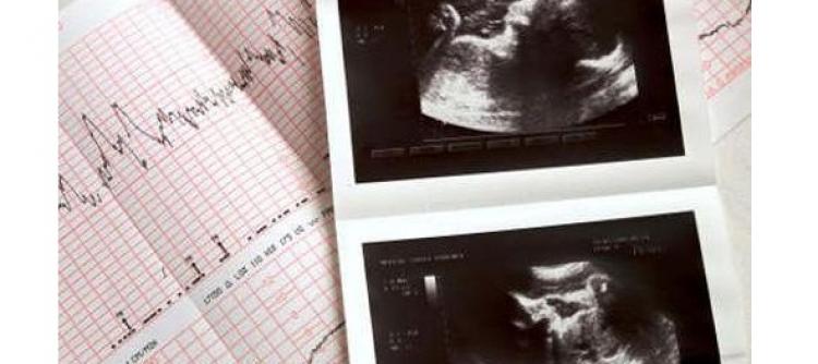 Diklaim Canggih, Adakah Efek Samping Radiasi dari USG 4D Terhadap Janin?