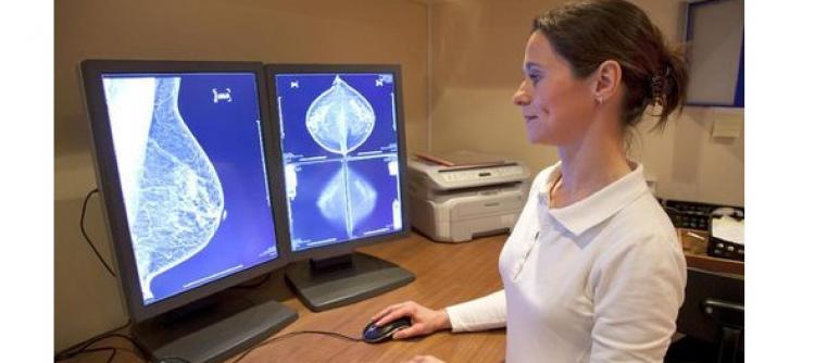 Beda Stadium, Beda Pula Penanganan Pasien Kanker Payudara